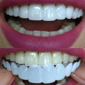 اسنپ آن اسمایل (لمینیت متحرک) snap on smile